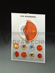 Eye Disorders 3D Lenticular Anatomical Chart